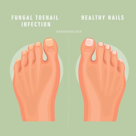 In The Beauty Light: Fungal Nail Infection - Mashion